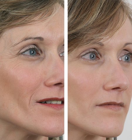 Power Tense - Wrinkle Power -  - La bonne remise