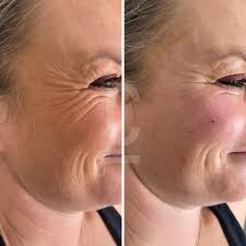 WRINKLE FILLER - Soin visage - La bonne remise