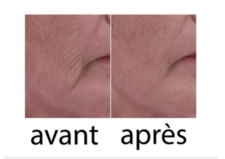 Wrinkle Filler X2 - - La bonne remise