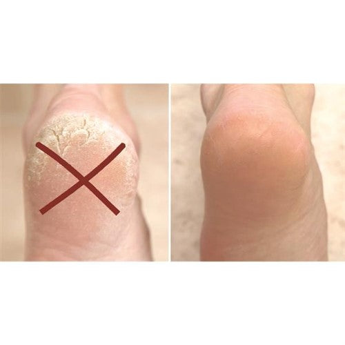 PEDIBLISS X1 - Soin des pieds - La bonne remise