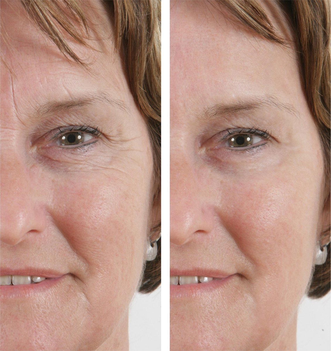 Wrinkle Filler X2 - - La bonne remise