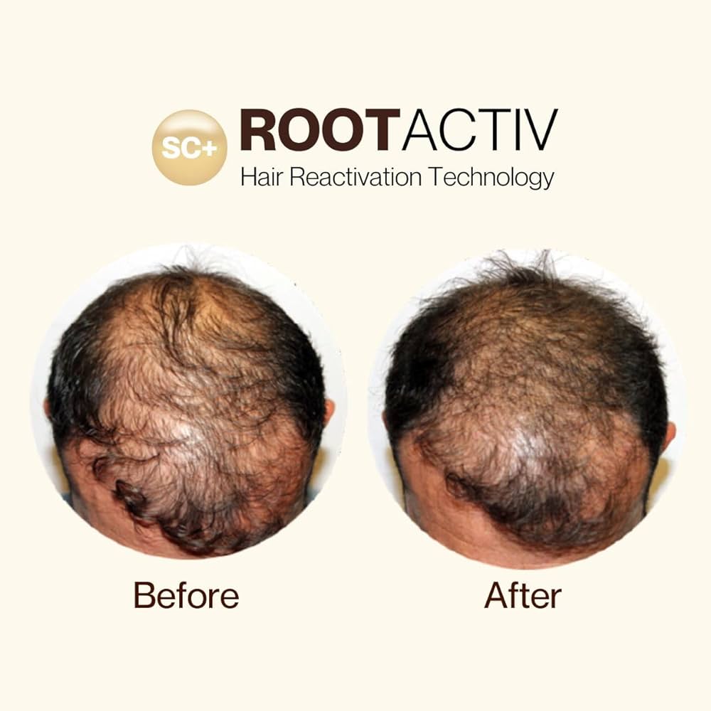ROOTACTIVE X3 -  - La bonne remise