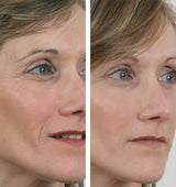 Wrinkle Filler X2 -  - La bonne remise